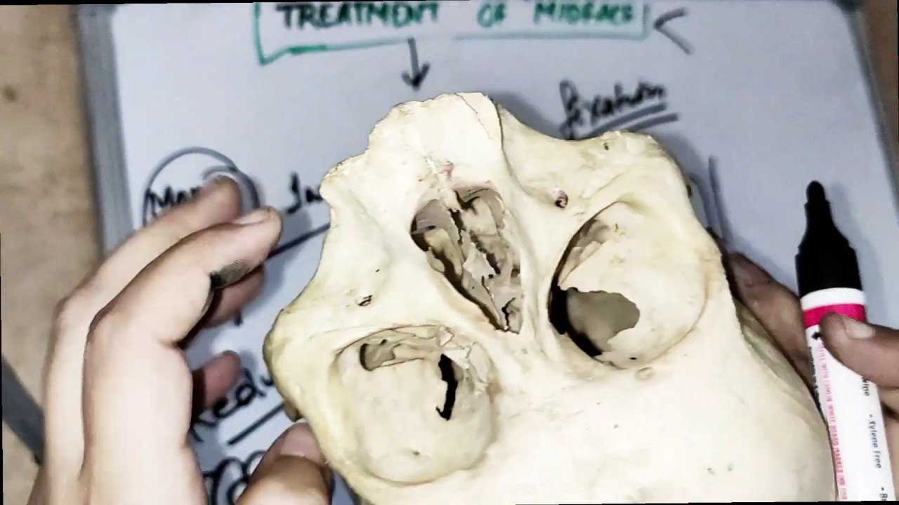 treatment of lefort fracture ( part1)