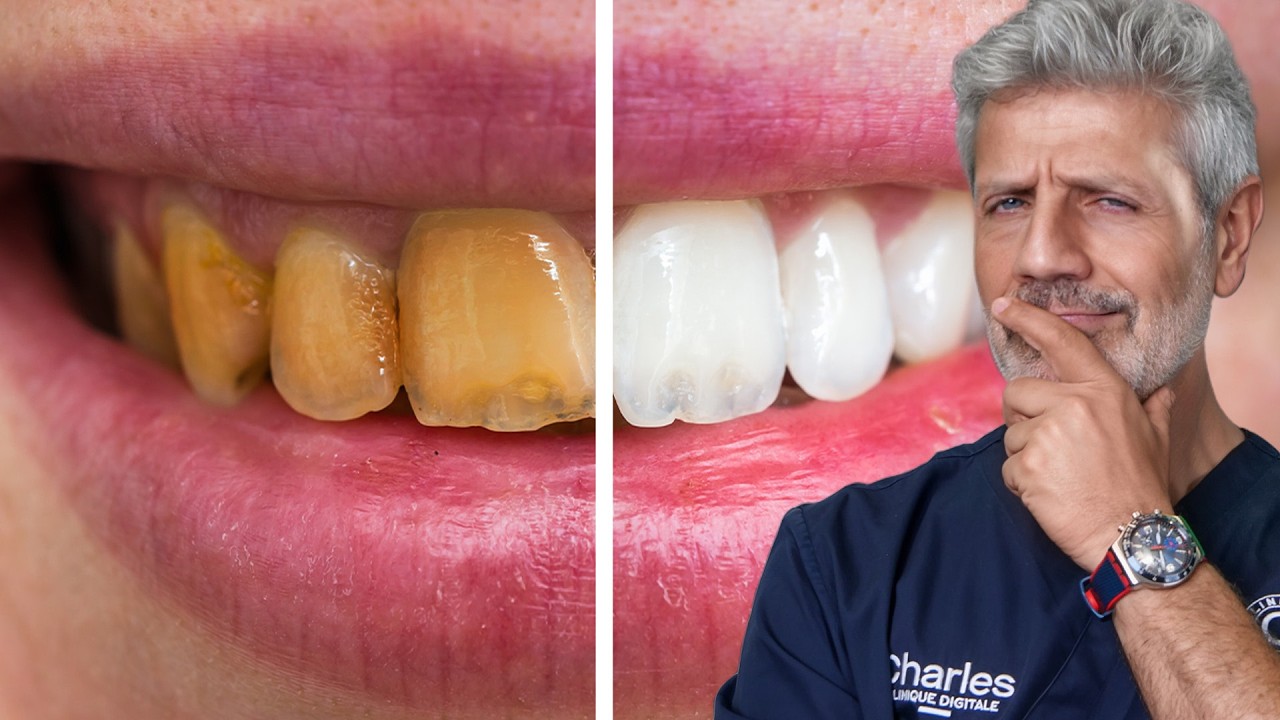 7 Astuces pour Avoir les Dents Blanches
