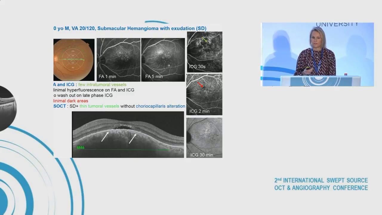 Dr Catharine Favard, MD, SS OCT & SS-AOCT contribution to the diagnosis of choroidal tumors