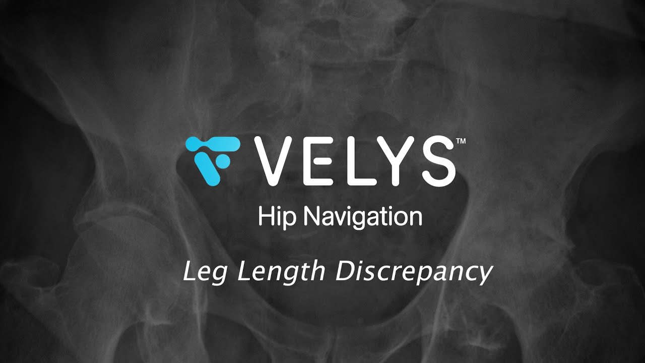 VELYS Hip Navigation with a Significant Leg Length Inequality