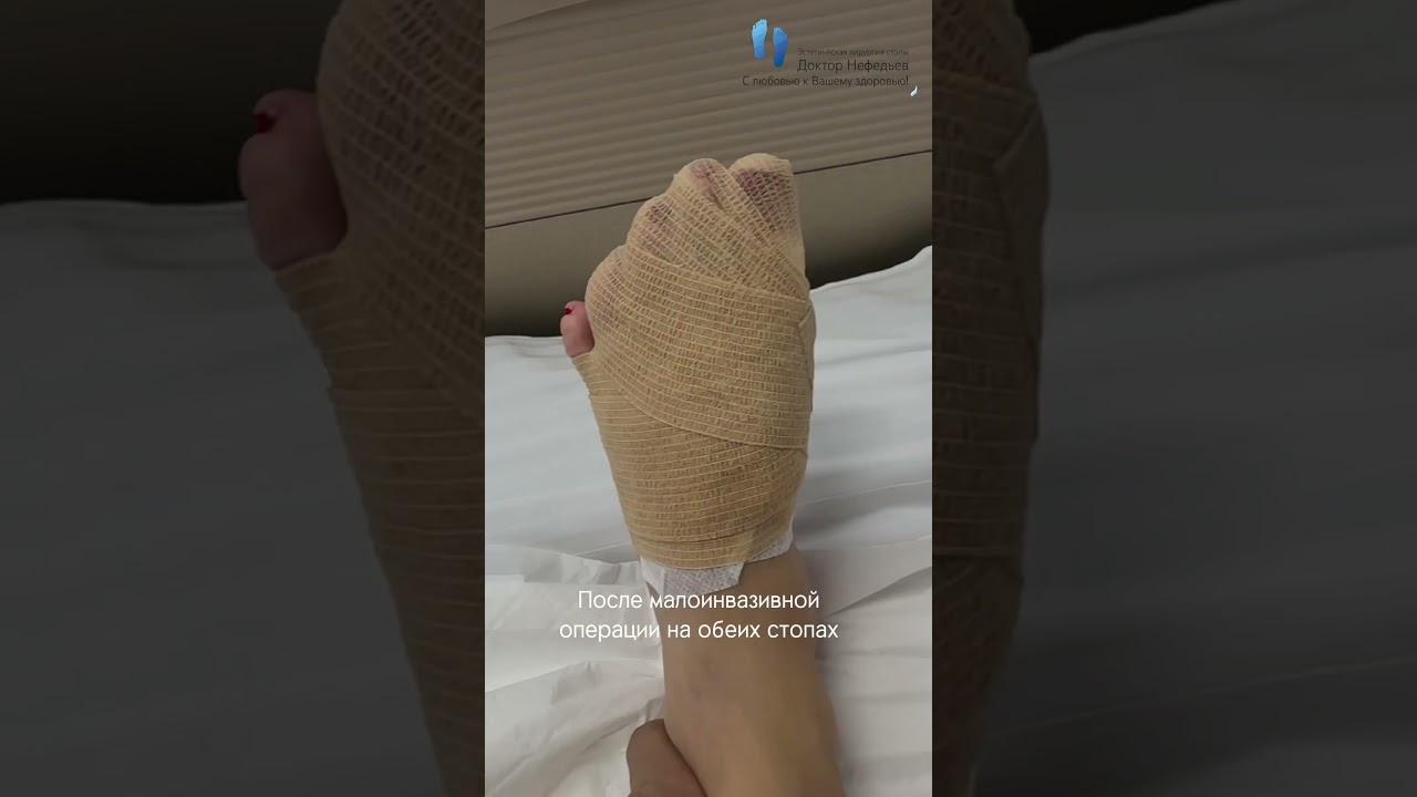 Результат коррекции HALLUX VALGUS #доктор #деформациястоп #вальгус