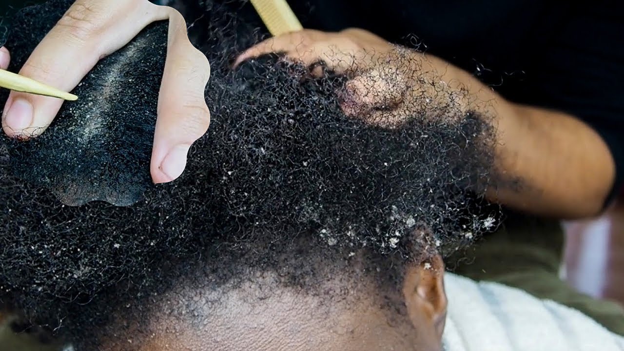 ASMR| Soothing Sounds Of Scalp Scratching ALOT OF DANDRUFF 😮‍💨