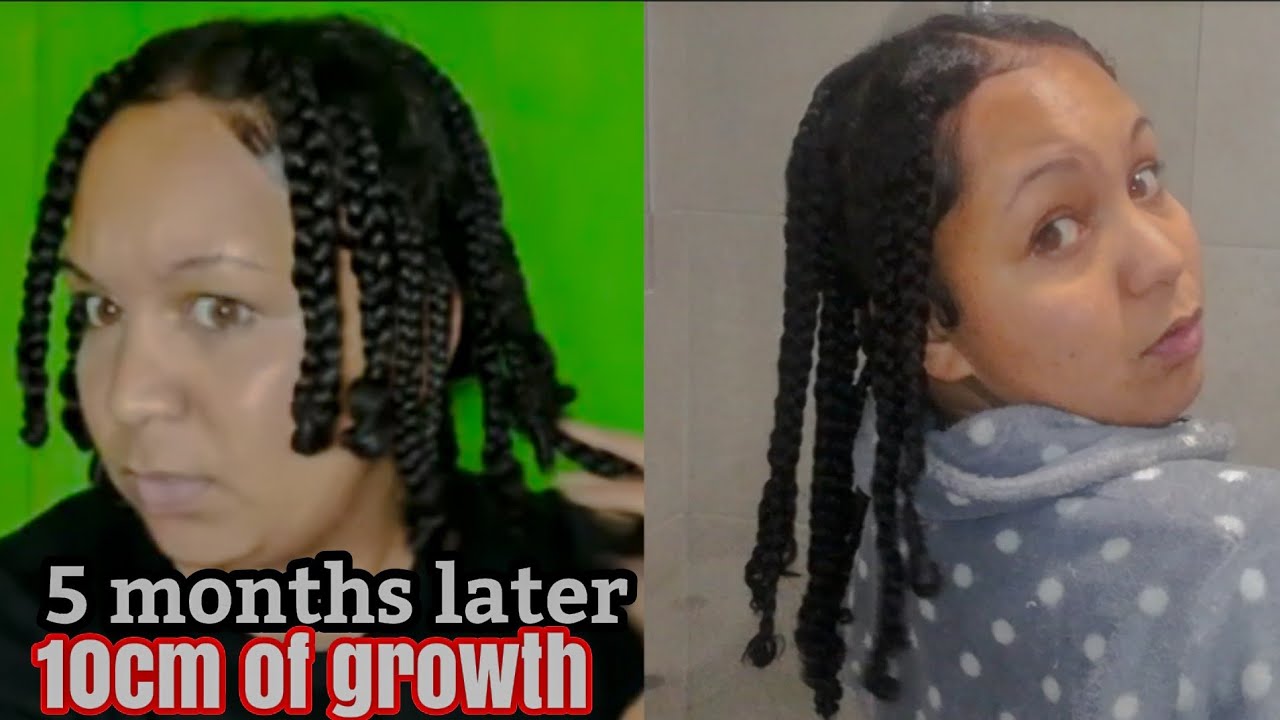 PLACENTA FOR HAIR GROWTH | 5 month update