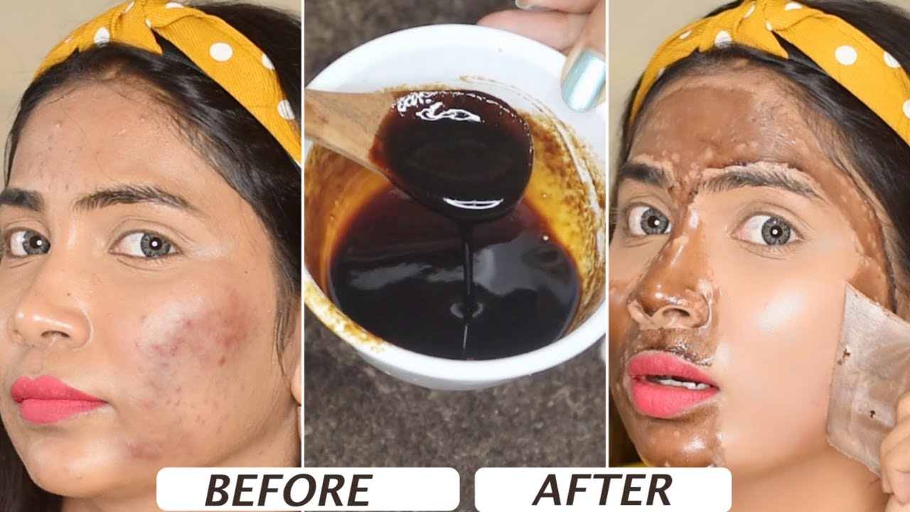 Coffee से ऐसे साफ़ हो जायेंगे चेहरे के काले दाग, झाइयां -उतर जायेगी काली परत- Pigmentation Treatment