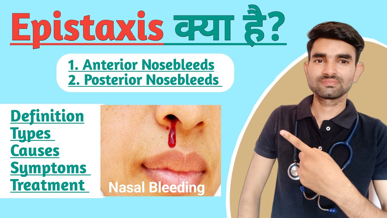 Epistaxis in Hindi | Causes, Symptoms and Treatment of Epistaxis | Nasal Bleeding