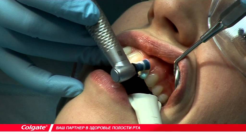 Методика нанесения десенситизирую​щей полировочной пасты Colgate&reg; Sensitive Pro Relief&trade;