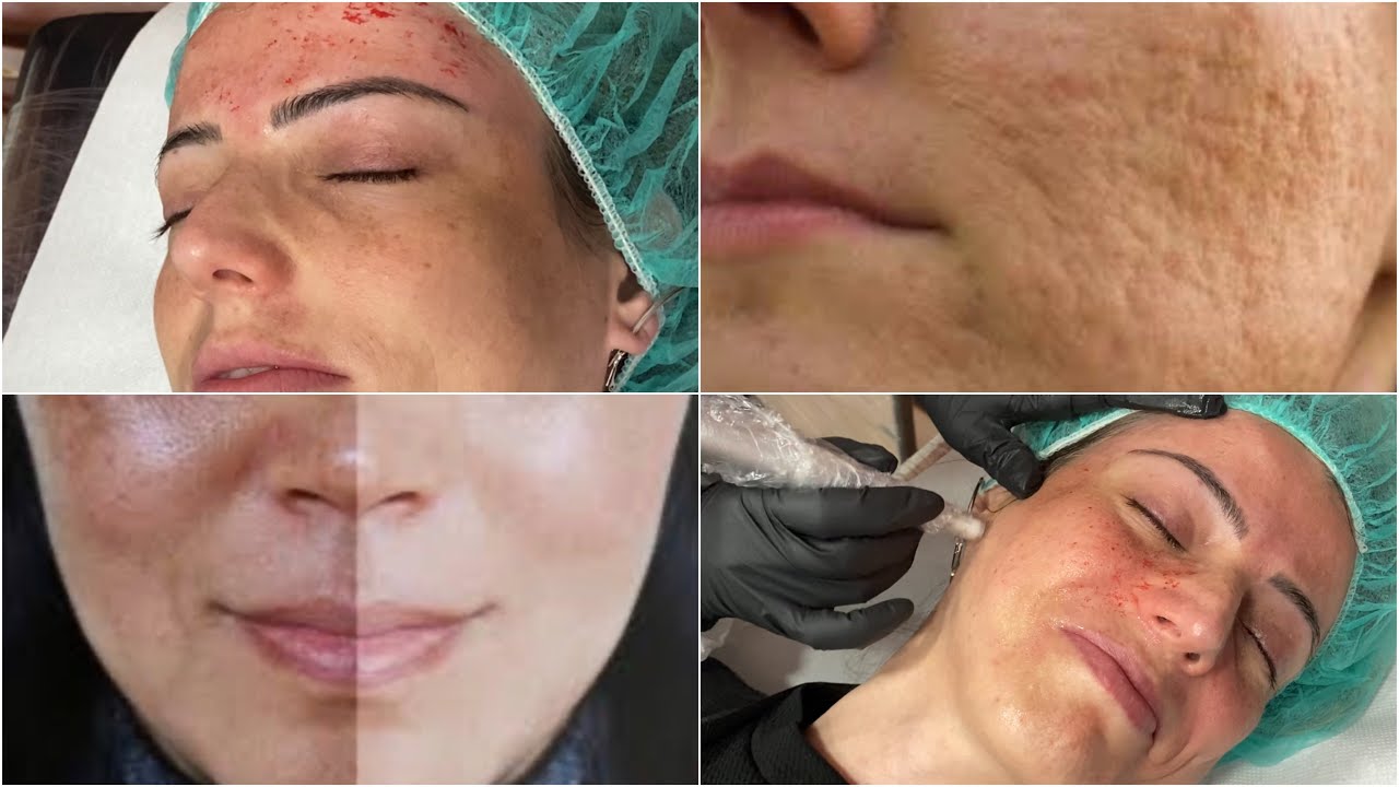 كورس حصري/التجميل بدون عمليات يهنيك من التجاعيد/الكلف/الوجه المحفر/المسامات الواسعة/ميكرونيدلينغ