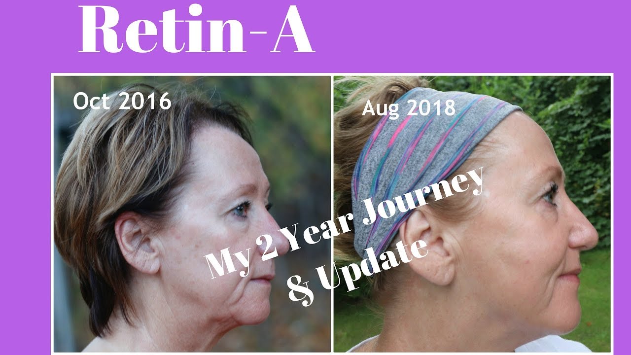 Retin-A | My 2 year journey with before and after | Monika's Beauty & Lifestyle