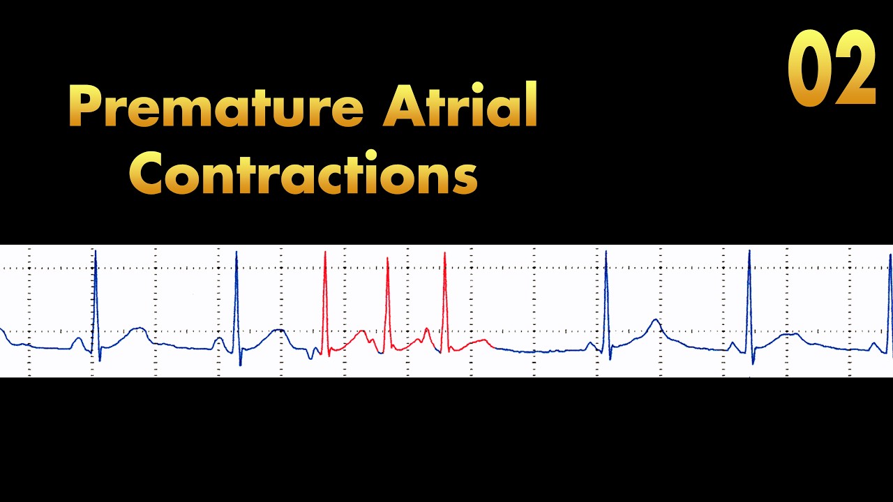 Premature Atrial Contractions (PACs): ECG Characteristics, Causes, Diagnosis and Treatment