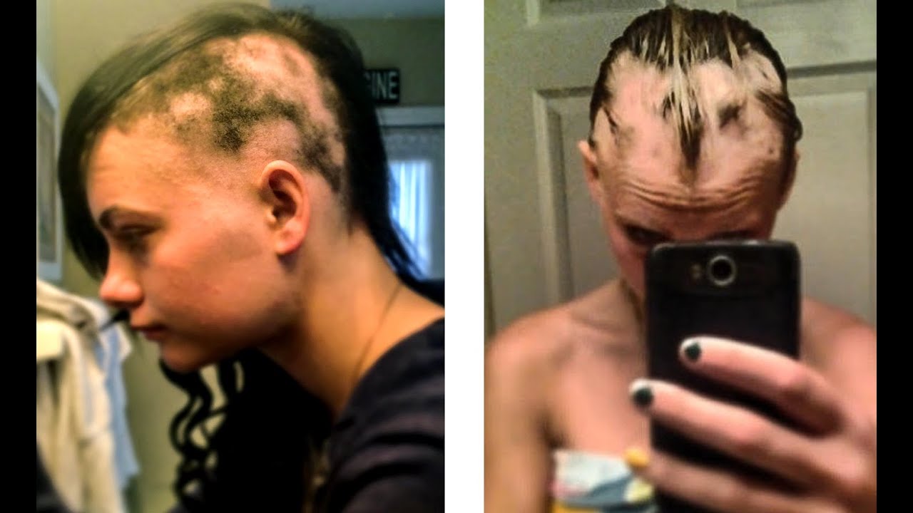 Living With Alopecia | HeyThereImShannon