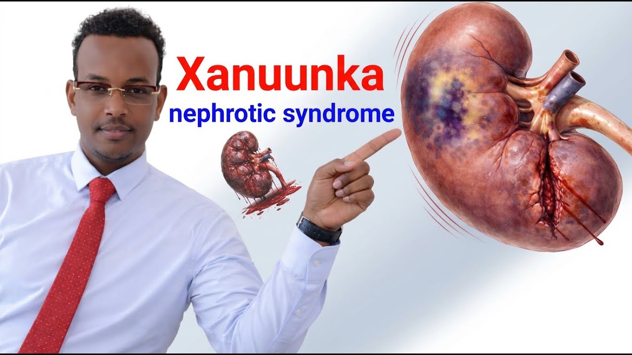 Halista Nephrotic Syndrome | Xanuunka Kiliyaha Dhaawaca ⚠️ Calaamadaha, Sababaha & Daaweynta