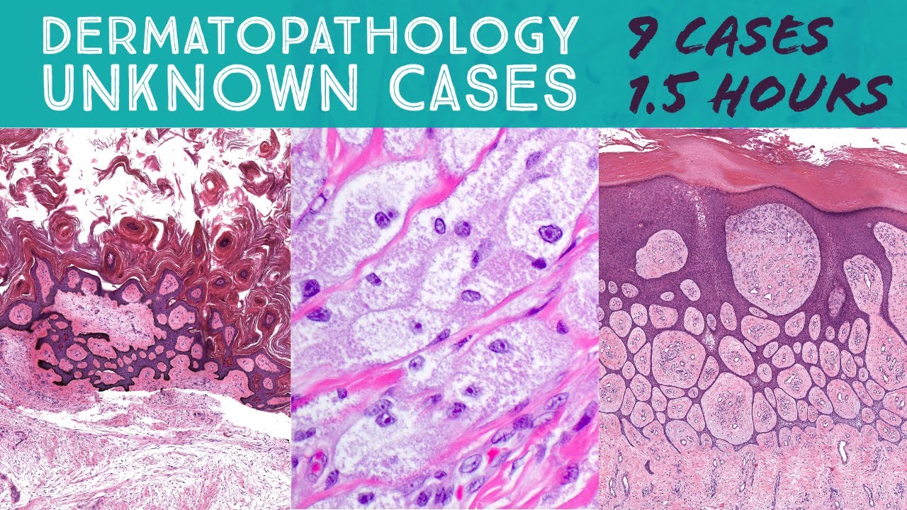Dermatopathology Unknown Cases (for University of New Mexico UNM Dermatology Residents) Board Review