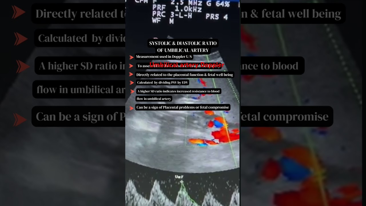 Umbilical artery Doppler in IUGR