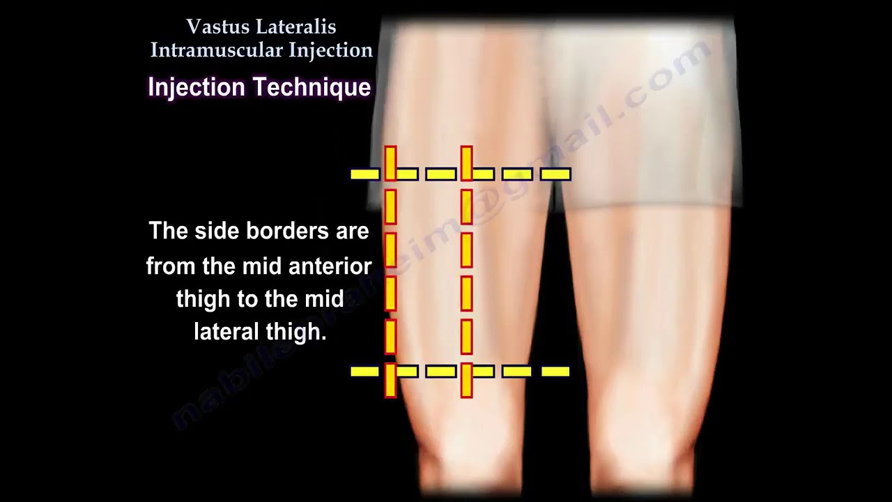 .Vastus Lateralis Intramuscular Injection: Safe and Effective Technique