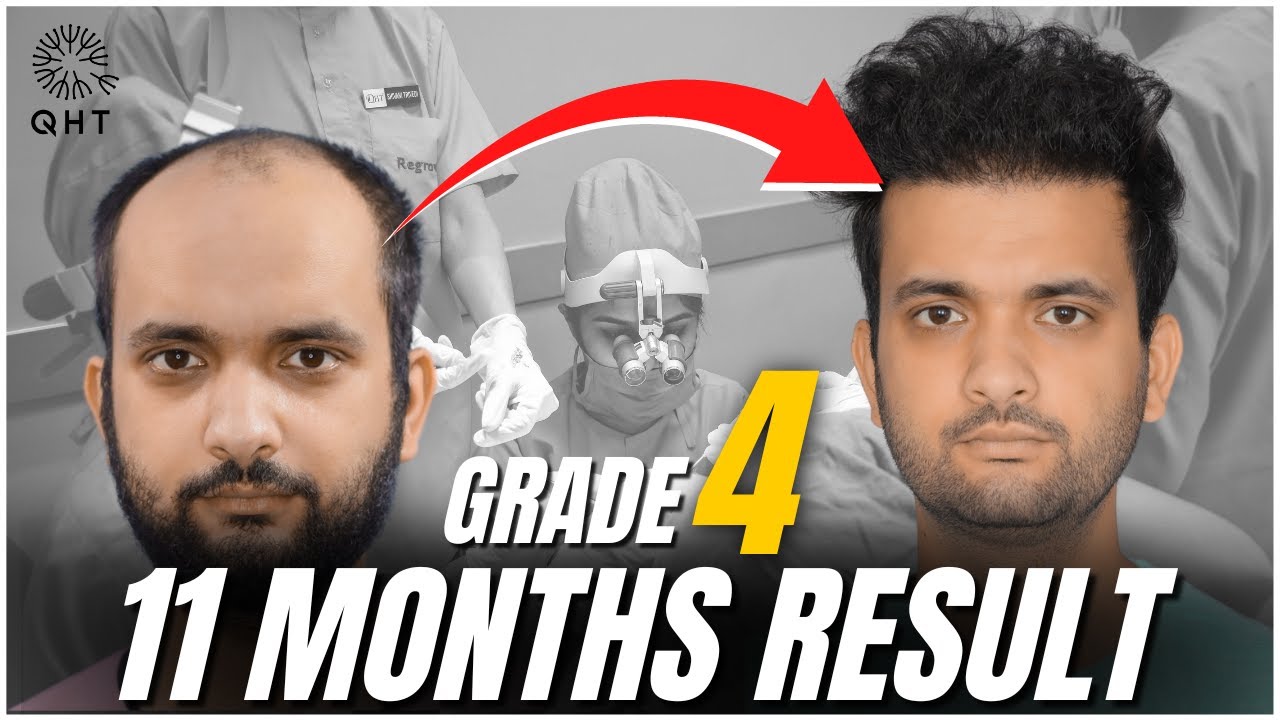 Best Hair Transplant Result 2022 | Grade 4 | Case Study | QHT Clinic Haridwar