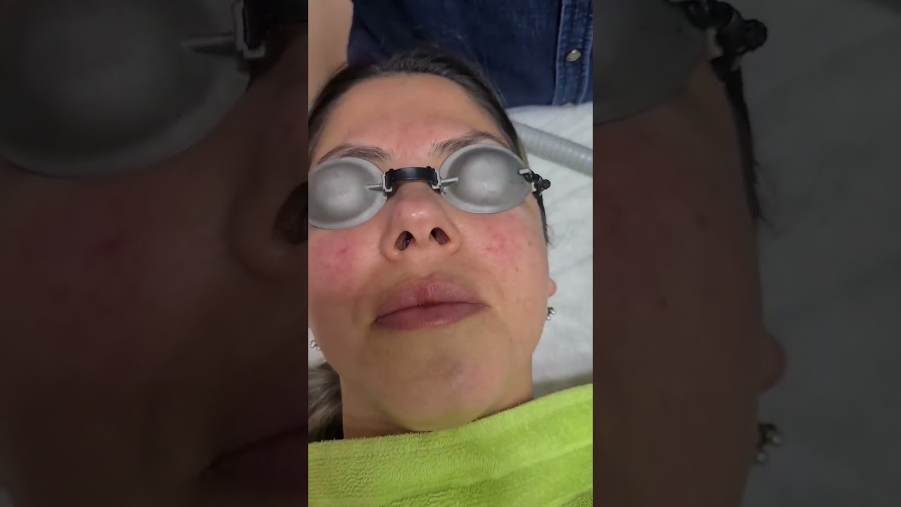 Rozasea Nedir Rozasea Tedavisi Nasıl Yapılır Dr. Okan DOST