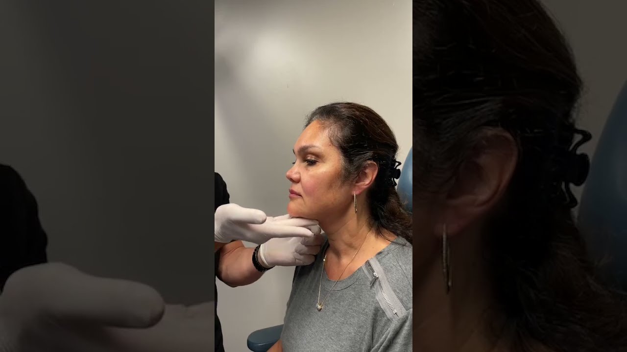Minimally-Invasive Neck Lift Results Revealed By NYC Facial Plastic Surgeon | Dr. Philip Miller