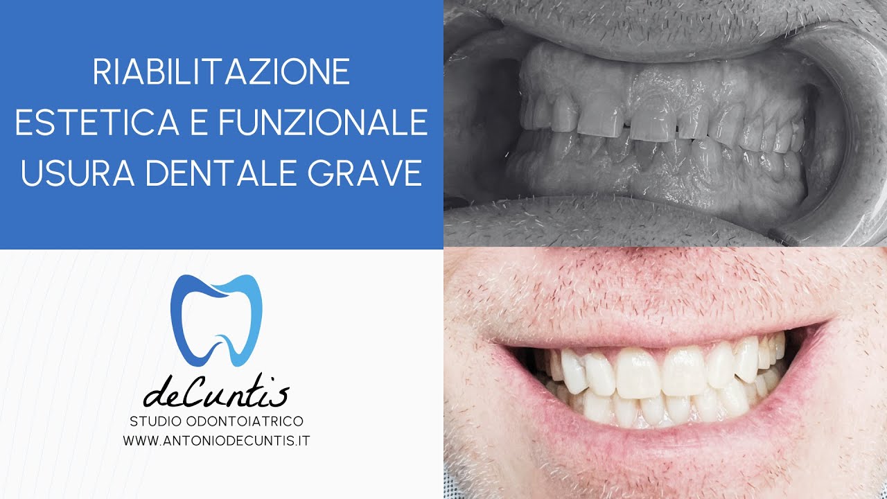 Riabilitazione Estetica e Funzionale usura dentale grave - Dott. Antonio de Cuntis