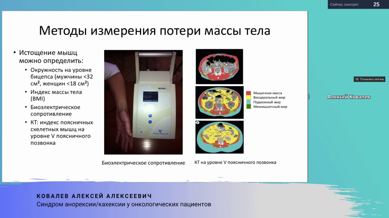 Синдром анорексии кахексии у онкологических пациентов Ковалев А  А