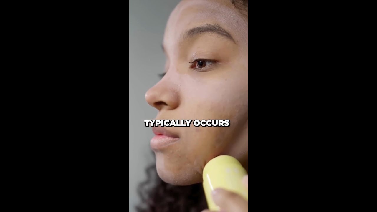 Conquer Hormonal Acne: The Power of Spironolactone