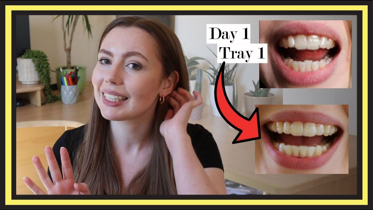 Invisalign Progress Update  |  Gum Recession, Gap Teeth, Black Triangles & Delays