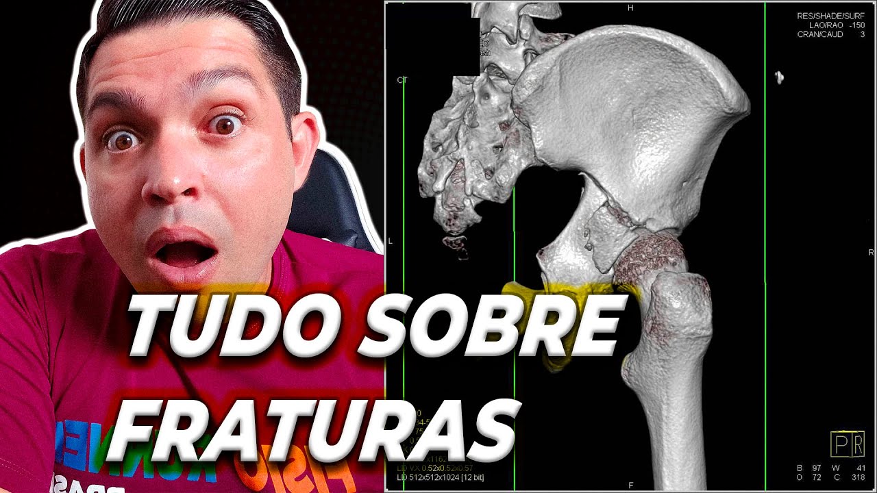 Tratamento para FRATURAS ÓSSEAS e a FISIOTERAPIA