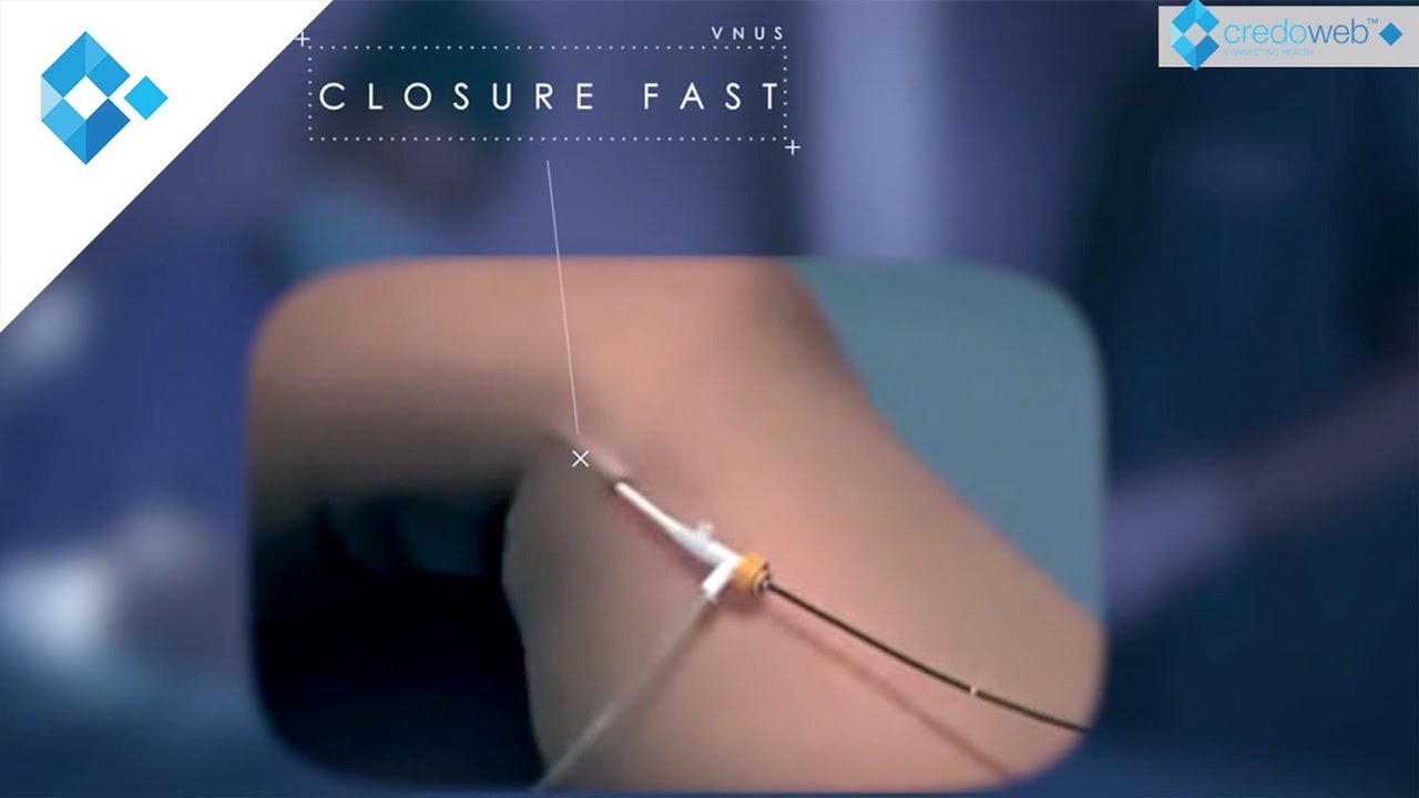 Venenerkrankungen - Closure Fast Methode