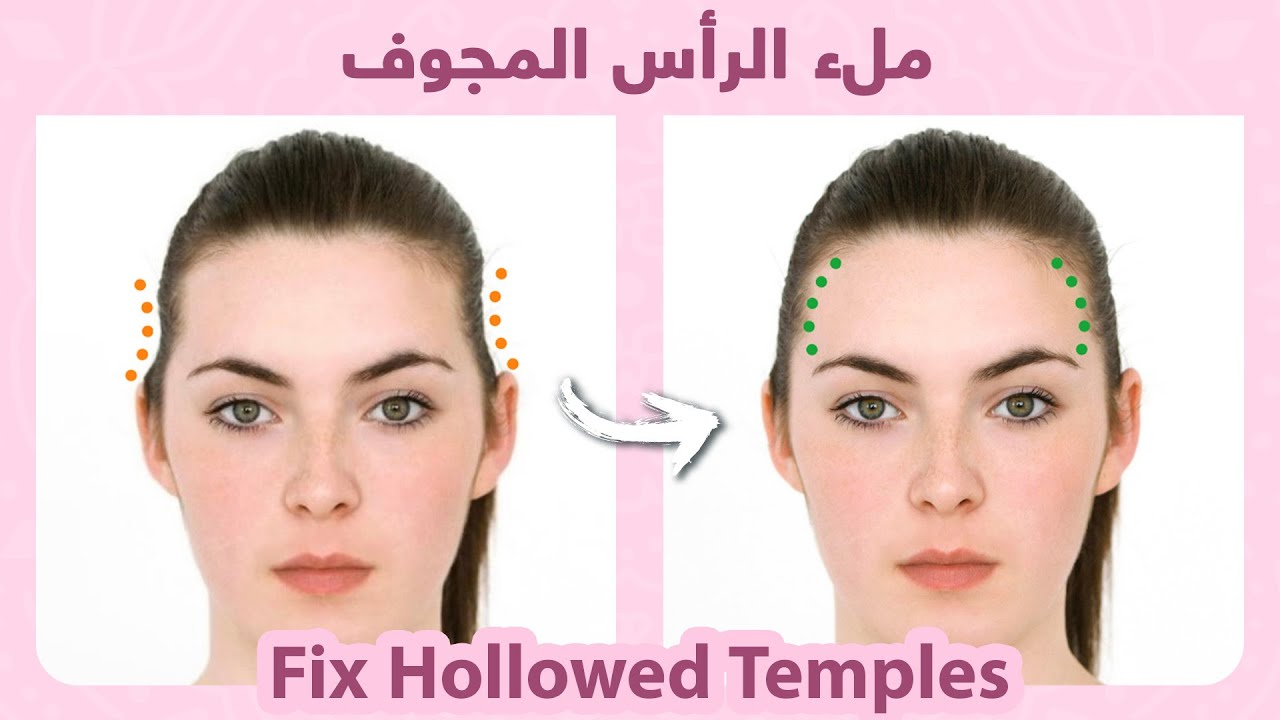 How to naturally fill hollowed or sunken temples | كيفية ملء الرأس المجوف، بشكل طبيعي