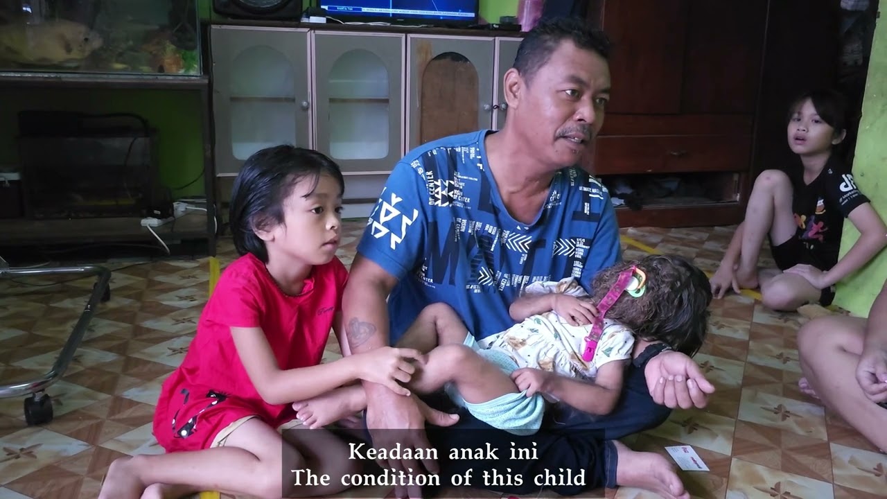 Congenital Generalised Hypertrichosis: First Malaysian toddler diagnosed with Werewolf Syndrome