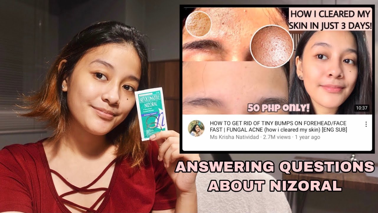 HOW TO APPLY NIZORAL ON FUNGAL ACNE (FULL DETAILS) | Ms. Krisha Natividad