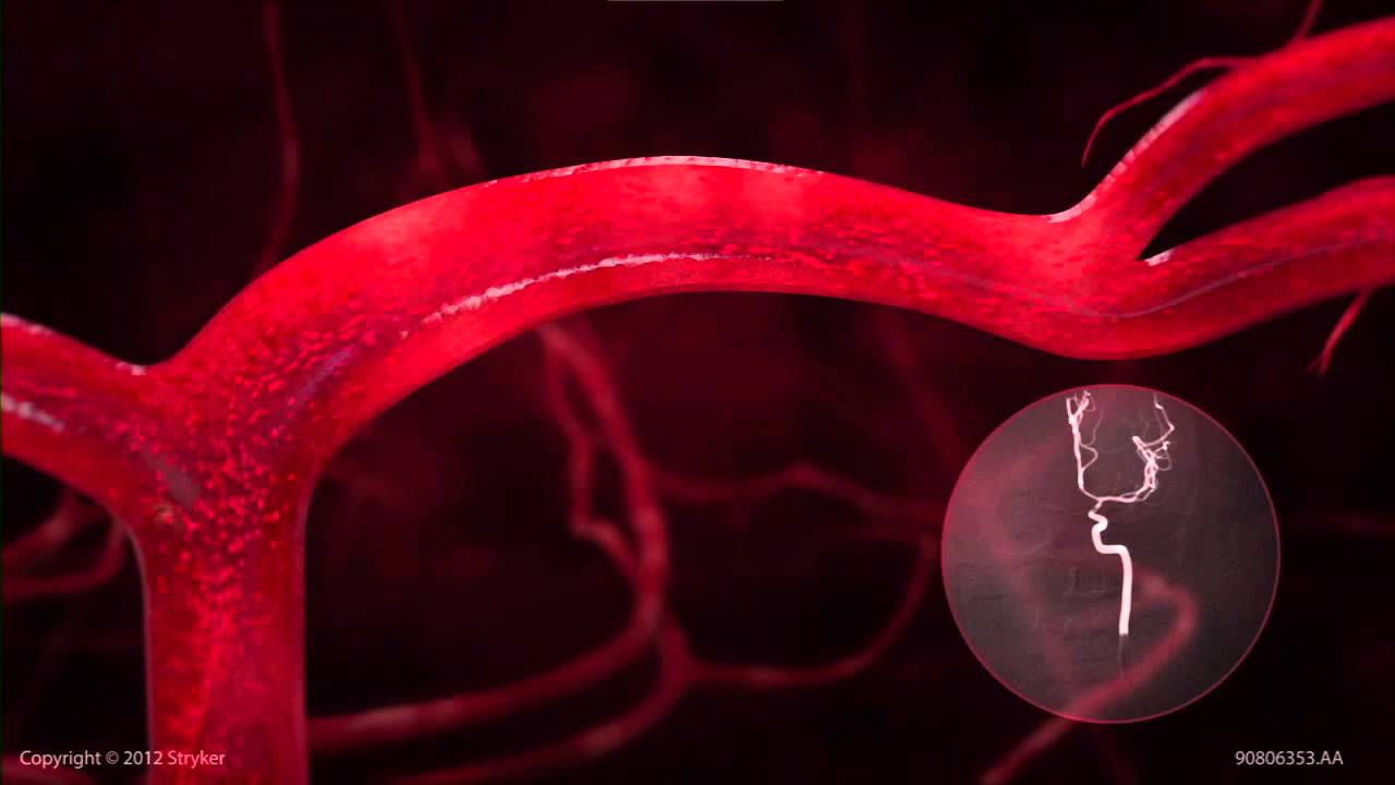 Stryker Neurovascular