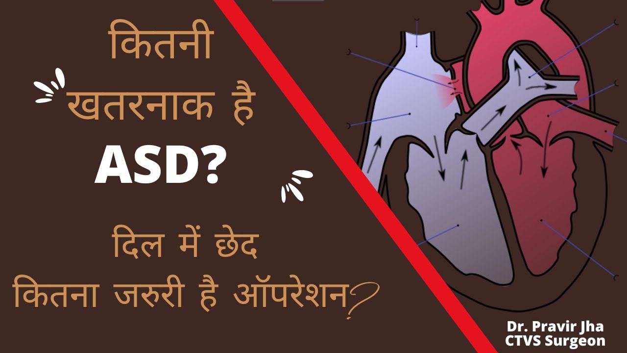 ASD Heart Defect | दिल में छेद | कितना जरुरी है जल्दी ऑपरेशन ? | ASD Device Closure | Dr. Pravir Jha