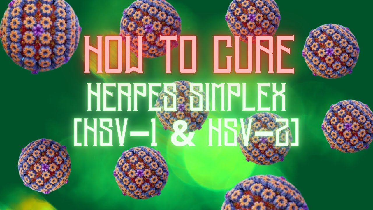 How to Cure - Herpes Simplex HSV 1 & HSV 2