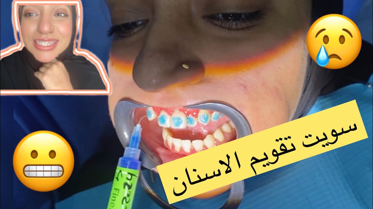 واخيرا ركبت تقويم اسنان وردي | تغير شكلي ١٨٠ درجة