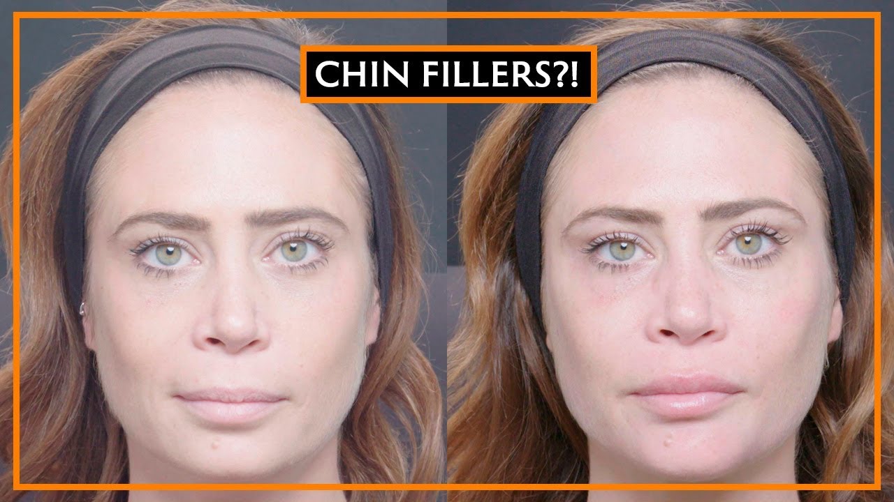 Dermal Fillers In The Chin