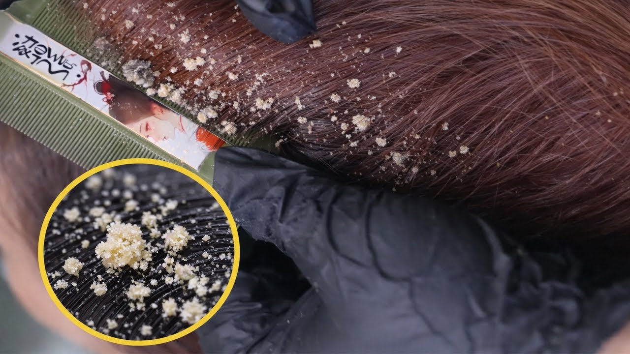 Deep Scalp Cleaning ASMR | Extreme Dandruff Removal & Relaxing Hair Care