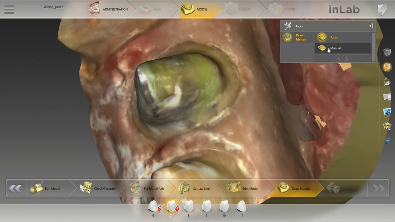 NEW Sirona InLab SW 18 Design Demo