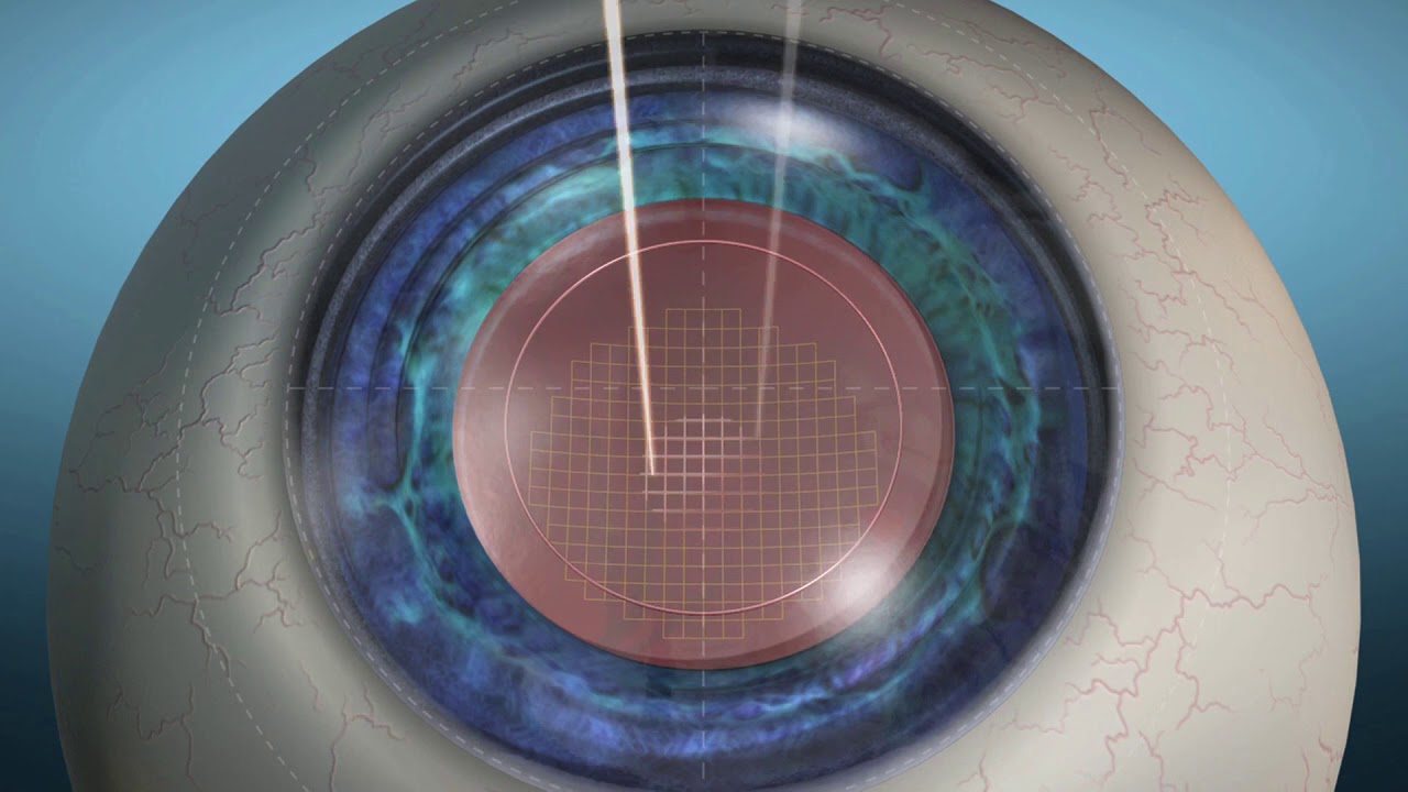 LenSx Femtosecond Laser Animation--How it works!