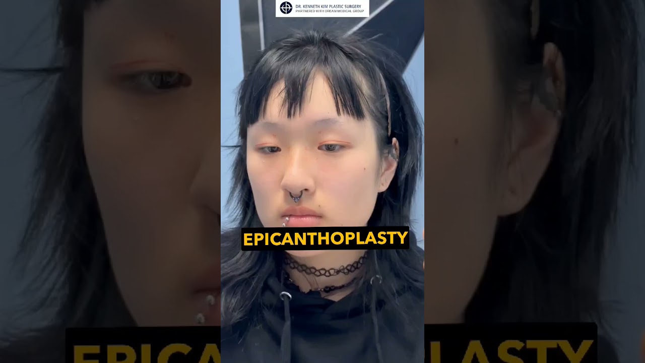 Pre-Op Evaluation for Double Eyelid and Epicanthoplasty Surgery | Dr. Kenneth Kim Plastic Surgery