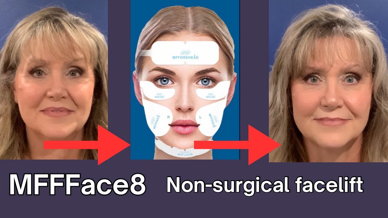 EFFFace8 | Безоперационная подтяжка лица | Безоперационная подтяжка лица до и после