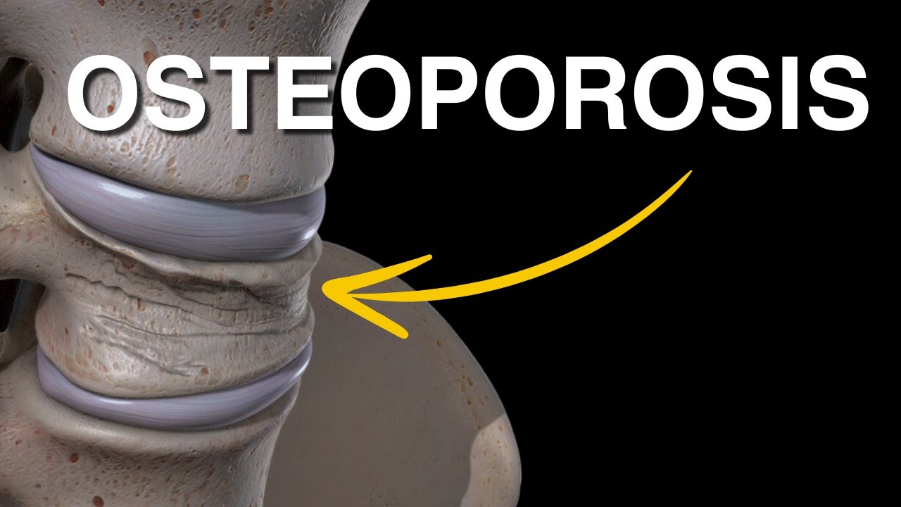 Osteoporosis Explicada Claramente