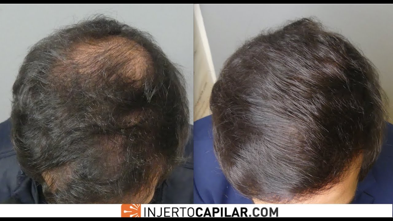 3101 FUE Grafts. Classic diffuse DUPA. 6 months early result . Injertocapilar.com. 2401/2019.