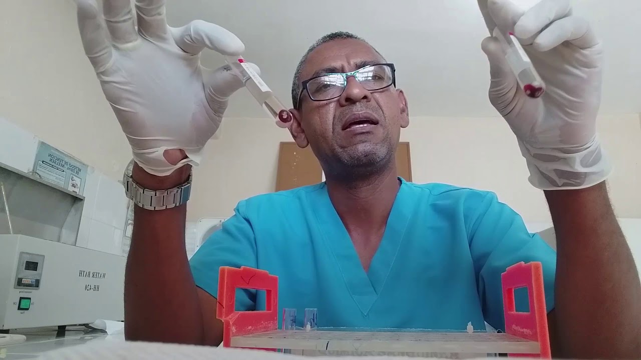 Determinacion del Antigeno D o Factor Rh.