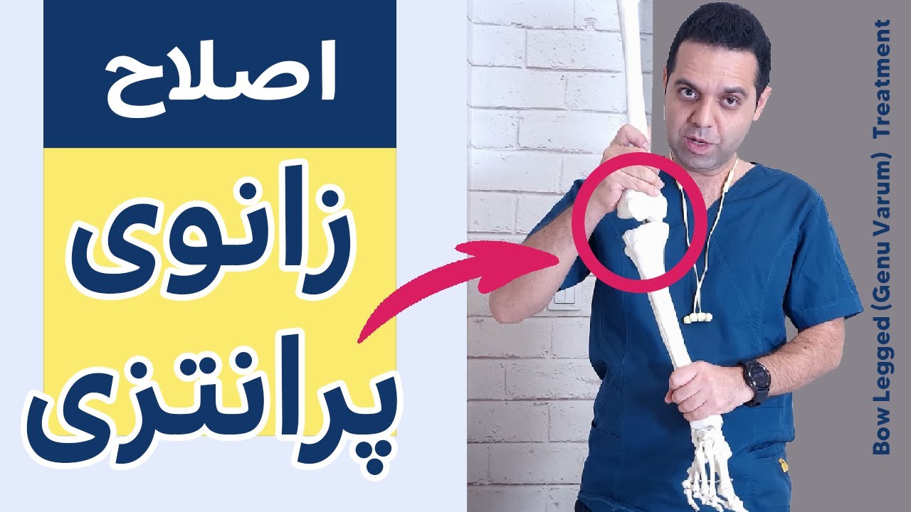 تمرینات اصلاحی زانوی پرانتزی | GENU VARUM/BOW LEG CORRECTION EXERCISES