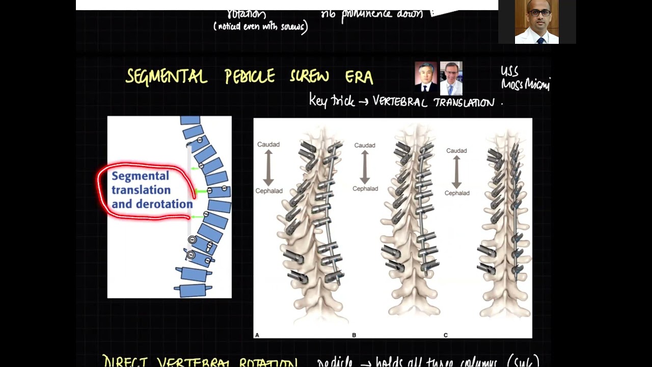 History of Corrective maneuvers in Adolescent Idiopathic Scoliosis surgery by Dr Kshitij Chaudhary