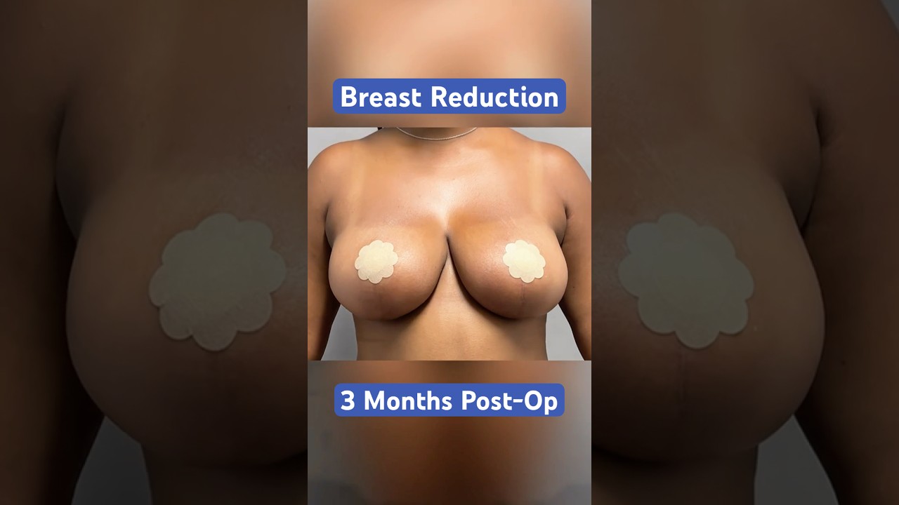 Breast Reduction Transformation You Need to See 👀 - Dr. Arsalan | West End Plastic Surgery