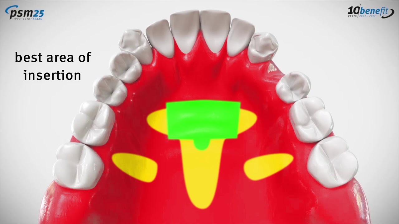 PSM ORGINAL BENEfit TAD Beneslider mesial/distal_09-2019