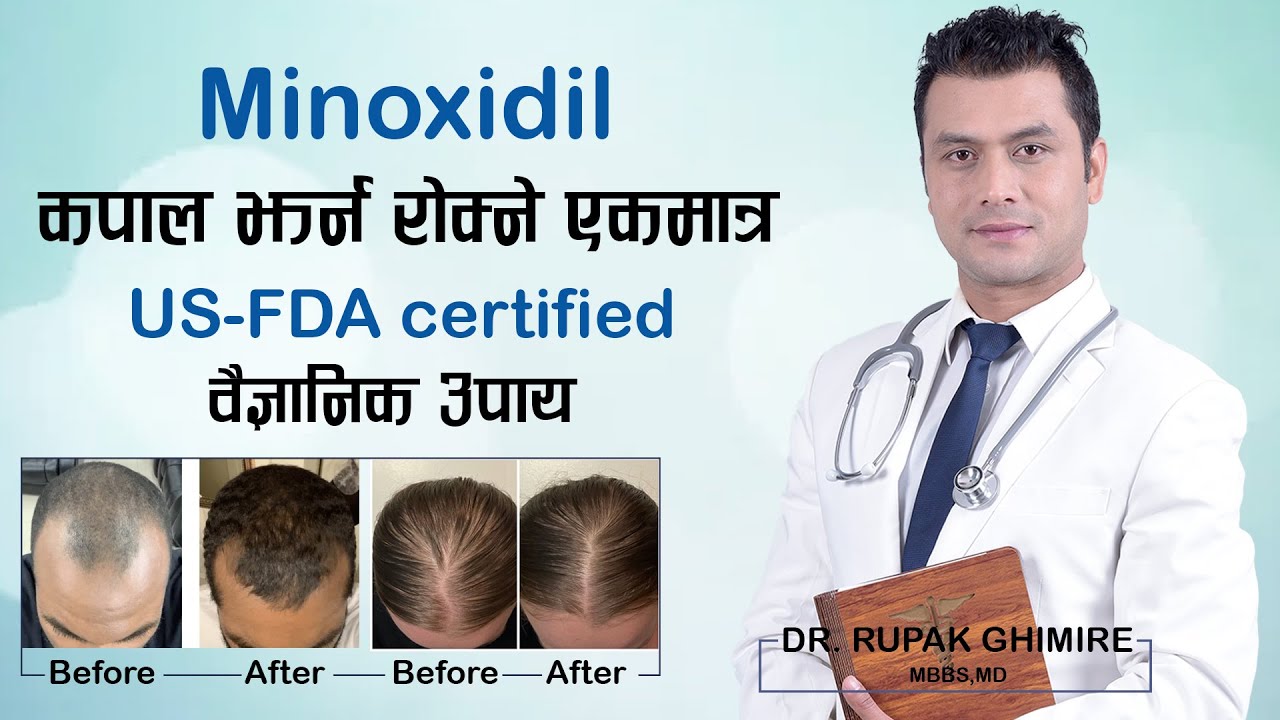 How To Use Minoxidil || Hair Regrowth | कपाल झर्न रोक्ने  एकमात्र  US-FDA Approved वैज्ञानिक उपाय