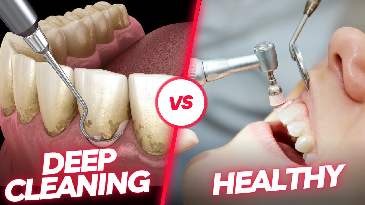 Deep Cleaning vs. Routine Cleaning: Unveiling the Dental Cleaning Process!