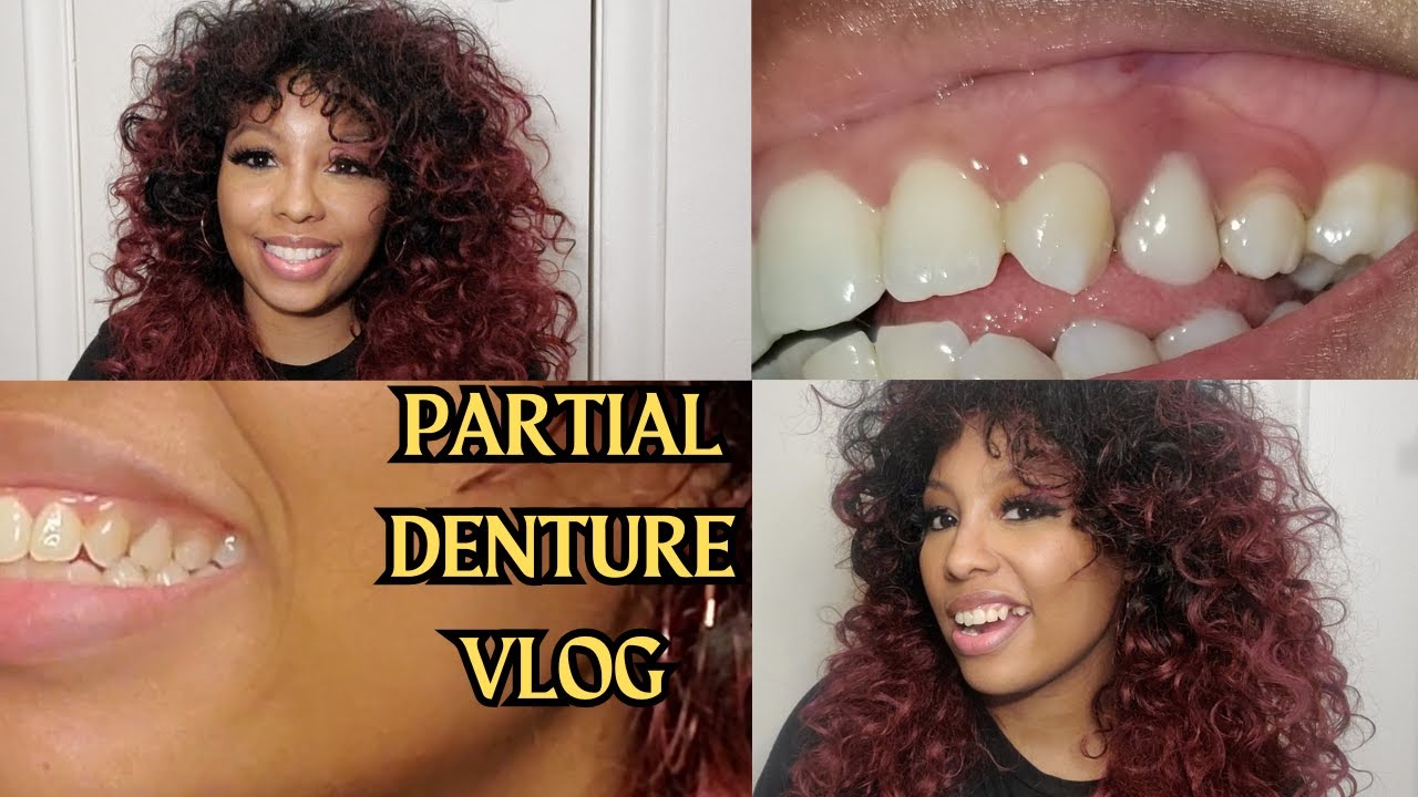 My First Week Having a PARTIAL DENTURE | what does having a partial denture look like, feel like?
